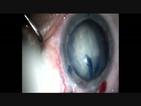 Die Rolle des ovalen Einschnitts bei der Subluxationslinse