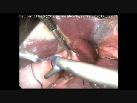 Laparoskopische Reparatur für perforiertes Magengeschwür