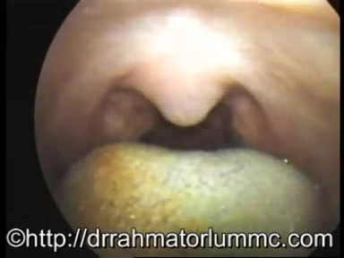 Kontraktionen der Uvula mit der Anhebung des Gaumensegels