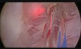 GreenLight-Laser Enukleation der Prostata - GreenLEP