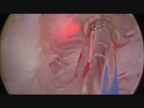 GreenLight-Laser Enukleation der Prostata - GreenLEP