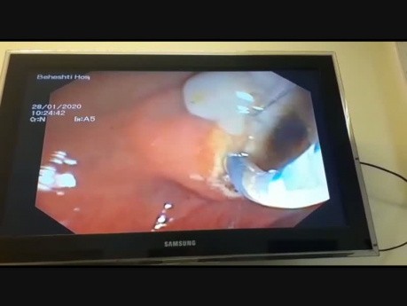 Leberhydatidzyste mit vorwölbung in den Ductus Choledochus Communis mit Cholangitis und Extraktion der Tochterzyste durch endoskopische retrograde Cholangiopankreatikographie (ERCP).