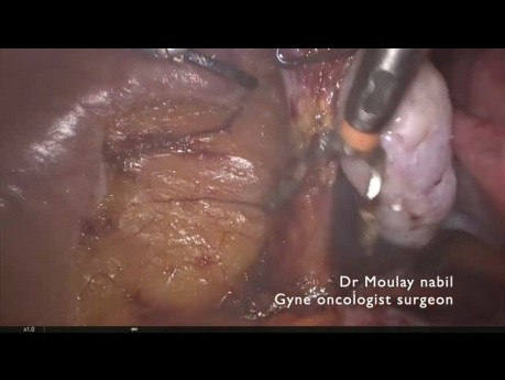 Hysterektomie beim Endometriumkarzinom