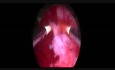 Hysteroskopische Entfernung eines beschädigten Intrauterinpessars (IUP).