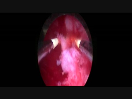 Hysteroskopische Entfernung eines beschädigten Intrauterinpessars (IUP).