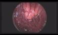 Eine neue Methode zur Behandlung von vesiko-rektalen Fisteln - anorektale Myoplastik mit TEM-Methode (transanale endoskopische Mikrochirurgie)