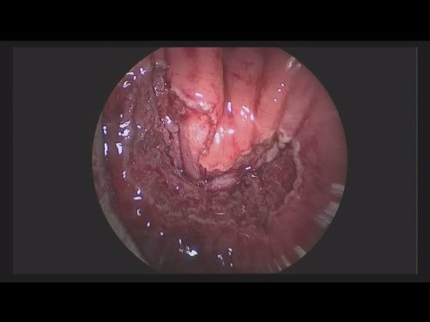 rectovesical fistula
