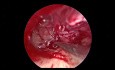 Endoskopische Revisionstympanoplastik bei Schallleitungsschwerhörigkeit
