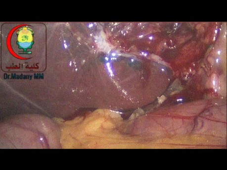 Blutungen im Bereich der Porta Hepatis, insbesondere bei Vorliegen von Anomalien wie dieser hinteren rechten Leberarterie