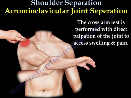 Schultergürtelverletzung - Videovorlesung