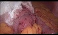 Magen-Bypass Operation