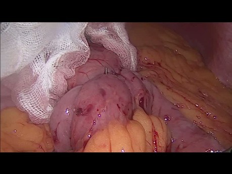 Magen-Bypass Operation