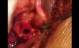 Chirurgie des Ductus choledochus