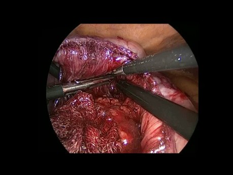 Die Umwandlung der VBG-Gastroplastik auf Magenbypass mit Roux-en-Y-Anastomose