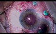 Carlevale IOL und Makulaforamen