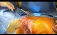 Minimalinvasive Lungentransplantation von A bis Z