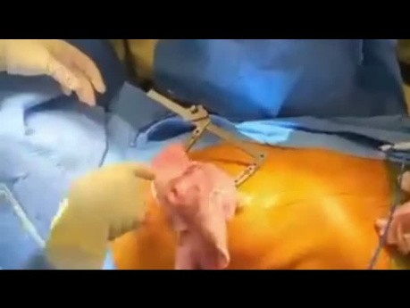 Minimalinvasive Lungentransplantation von A bis Z
