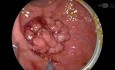 Minimal-invasive Mikrochirurgie (TEM) bei Rektumkarzinom – Schritt-für-Schritt-Vorgehen
