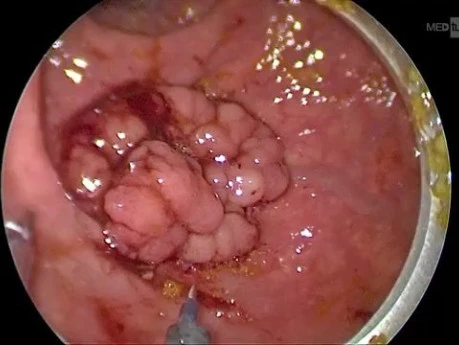 Minimal-invasive Mikrochirurgie (TEM) bei Rektumkarzinom – Schritt-für-Schritt-Vorgehen