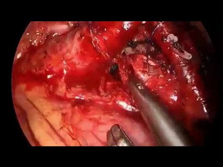 Minimalinvasive Umschlingung und Freilegung der linken Lungenarterie