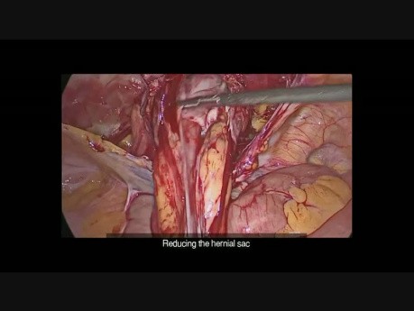 Hernienreparation durch TAPP-Methode - stufenweise
