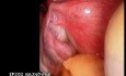 Diagnostische Laparokospie
