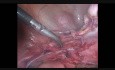 Laparoskopische Hysterektomie chronische Beckenschmerz 