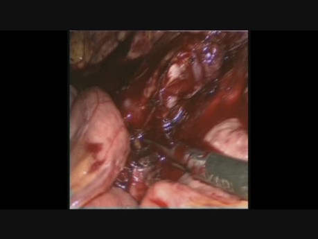 Laparoskopische Entfernung von peraortalen Knoten aufgrund von Krebs des linken Teils des Dickdarms - Behandlung von Blutungen