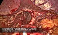 Laparoskopische Redo-Fundoplikatio