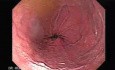 Die Magenulcera - Endoskopie - der sanduhrförmig Magen