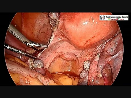 Laparoskopische Hysterektomie mit der Einlage der der Ureter-Dauerschiene
