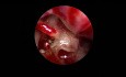 Endoskopische Stapedotomie bei Otosklerose (Diodenlaser)