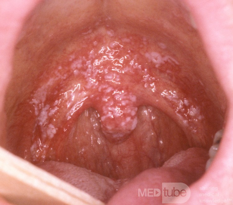 Orale Candidiasis