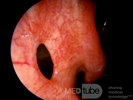 Antrostomie der unteren Meatus [rechts]
