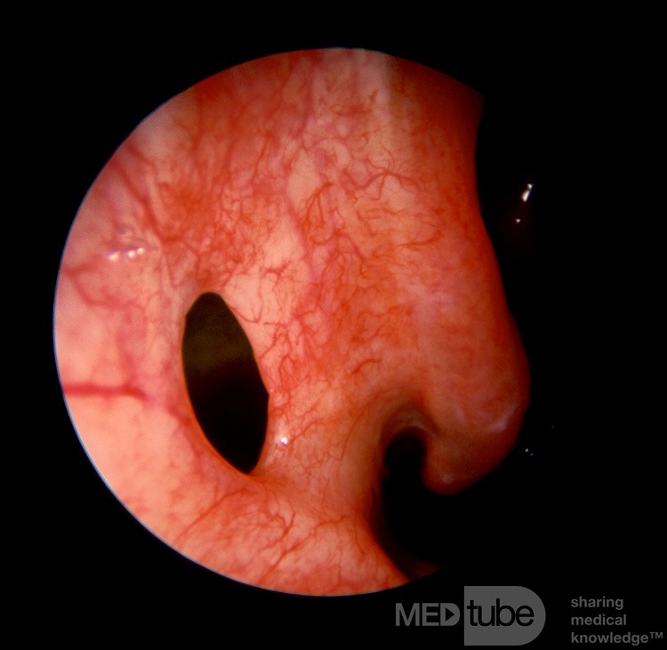 Antrostomie der unteren Meatus [rechts]