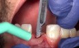 Sofortimplantation nach Zahnavulsion