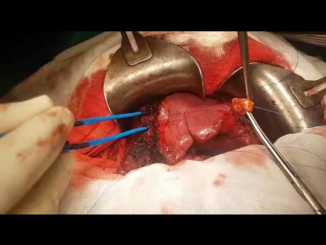 Anatomische Resektion von IVb- und V-Segmenten der Leber (Bisegmentektomie)