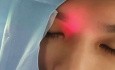 Transillumination des Sinus frontalis mit Lichtleiter vor Ballonsinuplastie