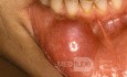 Riesige Mukozele der Lippe