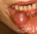Riesige Mukozele der Lippe