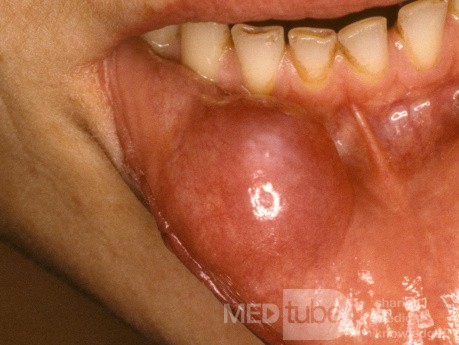 Riesige Mukozele der Lippe