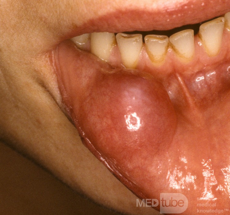 Riesige Mukozele der Lippe
