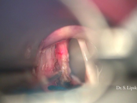Reoperation des Stimmlippenkarzinoms