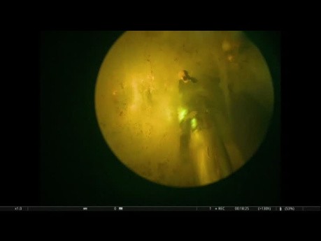 Enukleation der Prostata mit dem GreenLight-Laser
