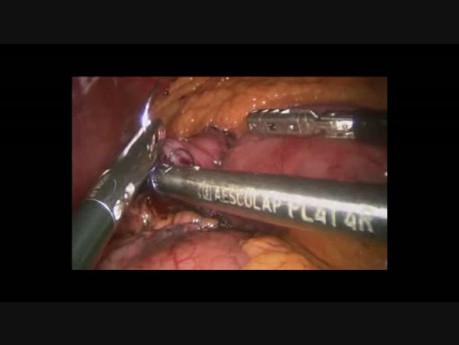 Roux-en-Y-Magenbypass mit Doppel Loop Technik
