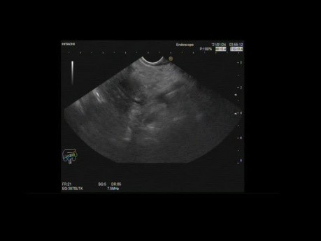 Endoskopischer Ultraschall einer großen Bauchspeicheldrüsenmasse