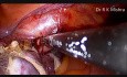 Laparoskopische Hysterektomie von große Gebärmutter