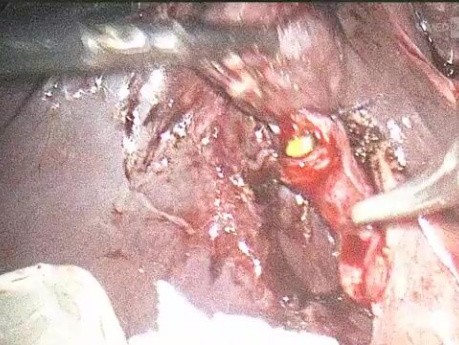 Der Umgang mit Steinen im Ductus cysticus erfordert einen geduldigen Chirurgen