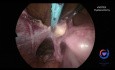 vNOTES Hysterektomie