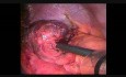 Magennekrose bei Zwerchfellhernie bei einem Patienten mit Magenband